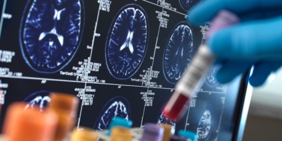 Neurological conditions affect 3.4B people worldwide. What about Canada? – National