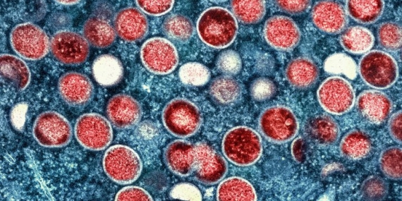 Mpox emergency declared in Africa amid surge in cases – National
