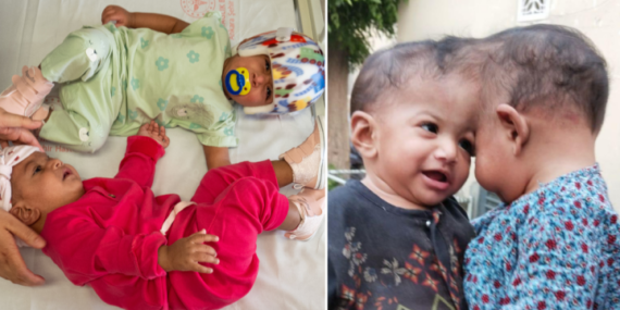 Twins conjoined at the head separated in marathon 14-hour surgery – National