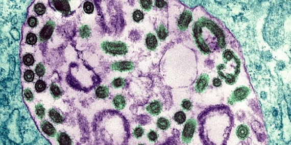After Marburg virus fears spread in Germany, is Canada also at risk? – National